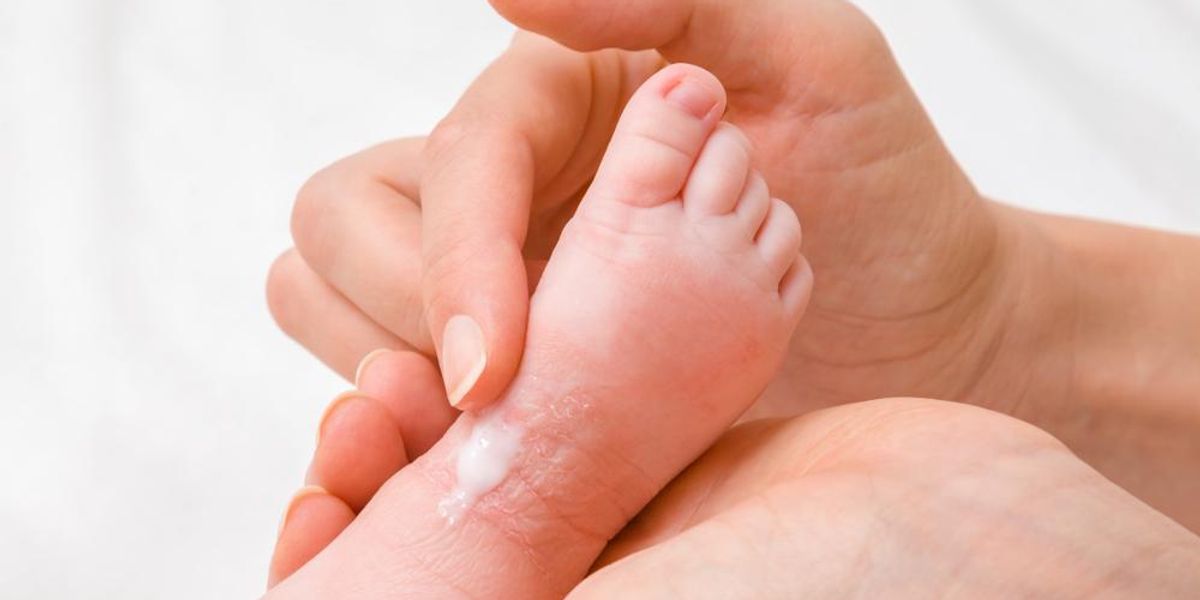 Kisbabája ekcémás lábát kenő női kéz
