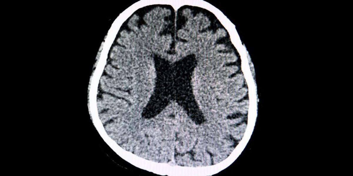 Egy agysorvadásos beteg agyának CT-vizsgálata, amelyen nagy kamrák és az agyszövet általános zsugorodása látható