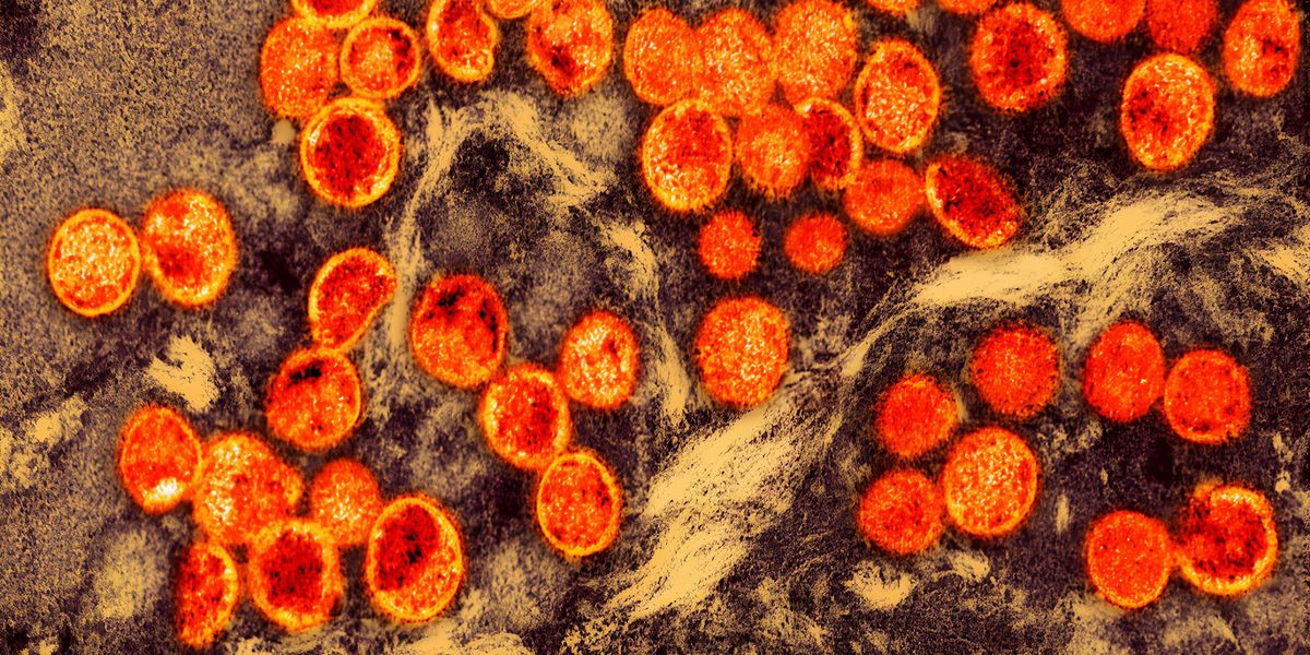 Színezett transzmissziós elektronmikroszkópos felvétel a laboratóriumban tenyésztett, fertőzött sejtben (barna) található majomhimlő vírus részecskékről (narancssárga)