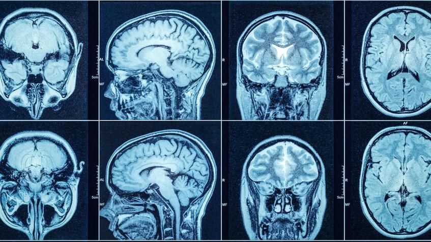 Egy emberi agyról készített röntgenfelvétel