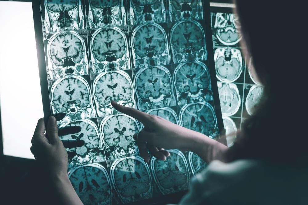 Alzheimer-kór MRI-felvétel