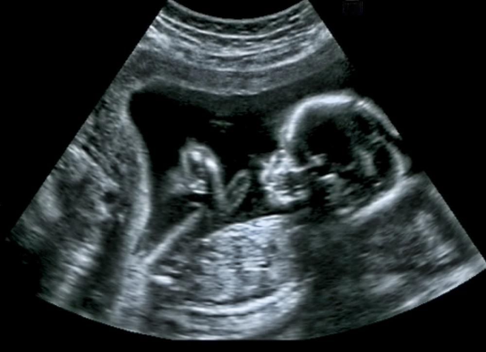 Ultrahangfelvétel az anya méhében lévő magzatról