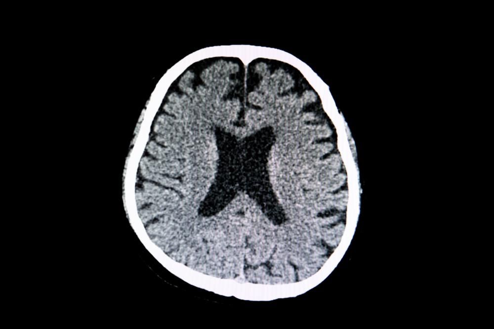 Egy agysorvadásos beteg agyának CT-vizsgálata, amelyen nagy kamrák és az agyszövet általános zsugorodása látható