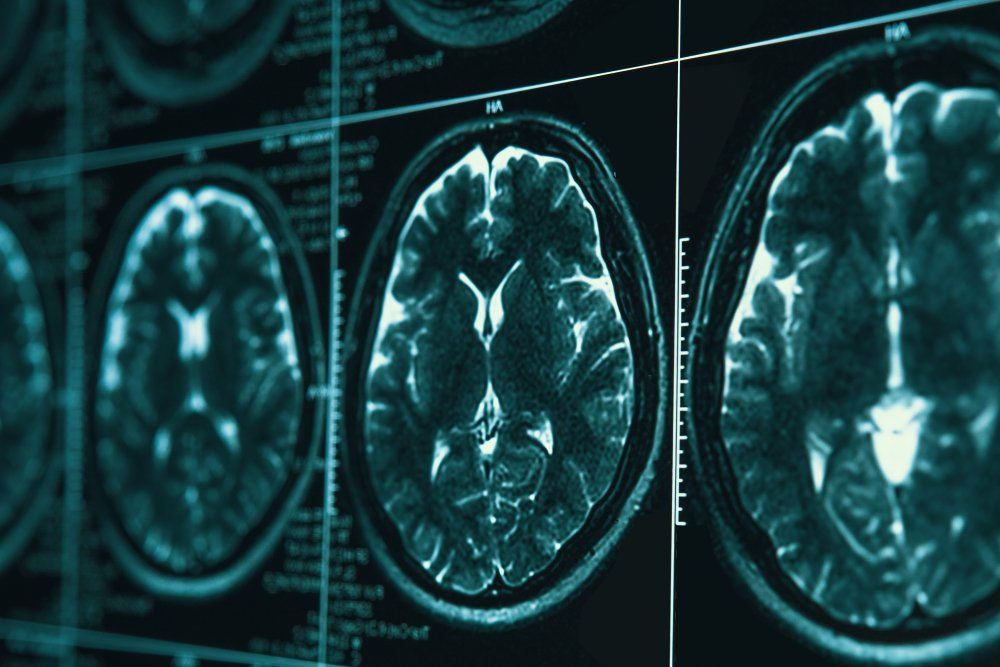 MRI-kép a fejről és az agyról