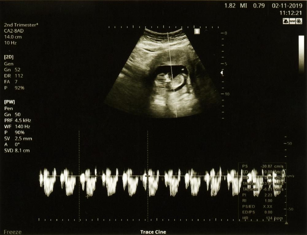 Szívhang vagy nem szívhang: az itt a kérdés