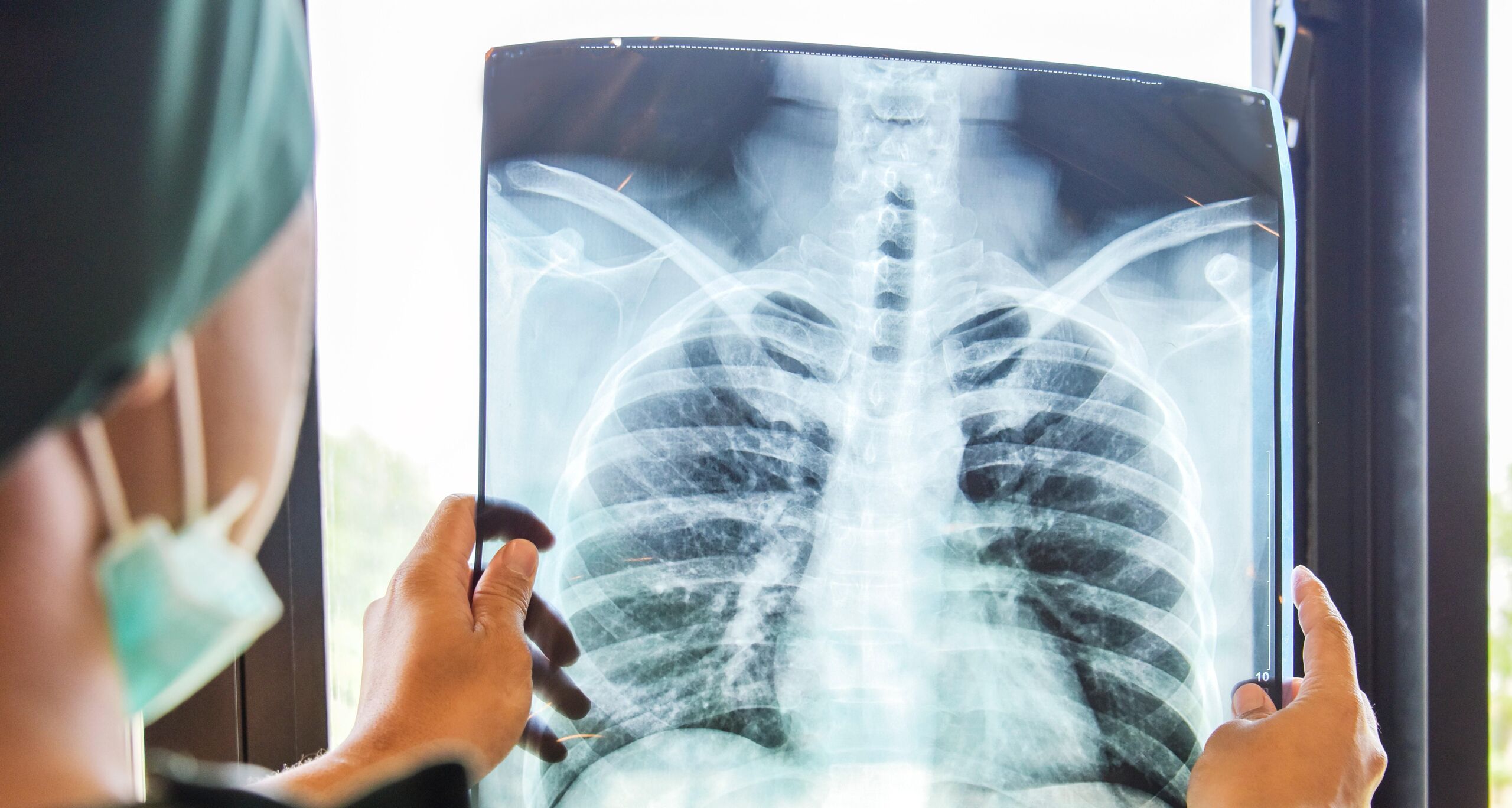 Egy népszerű vitamin megnövelheti a tüdőrák kockázatát