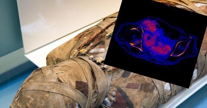 Megtalálták az első várandós egyiptomi múmiát, tartósított magzattal a hasában