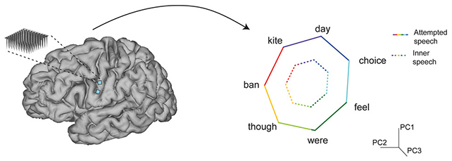 Ez a hihetetlen agyi implantátum képes a gondolatainkat beszéddé alakítani