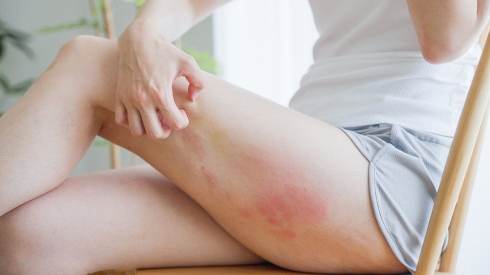 5 gyakori ekcéma mítosz, amit egyszer és mindenkorra felejtsünk el!