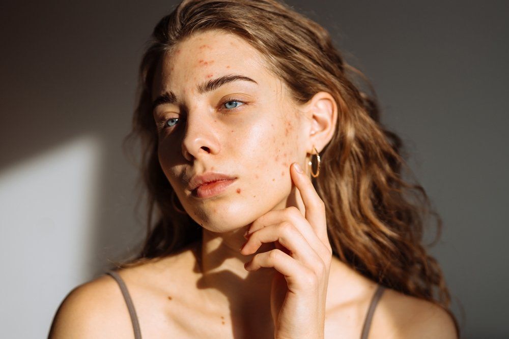 A legújabb akne kezelési TikTok-trükk komoly rákkockázatot jelenthet