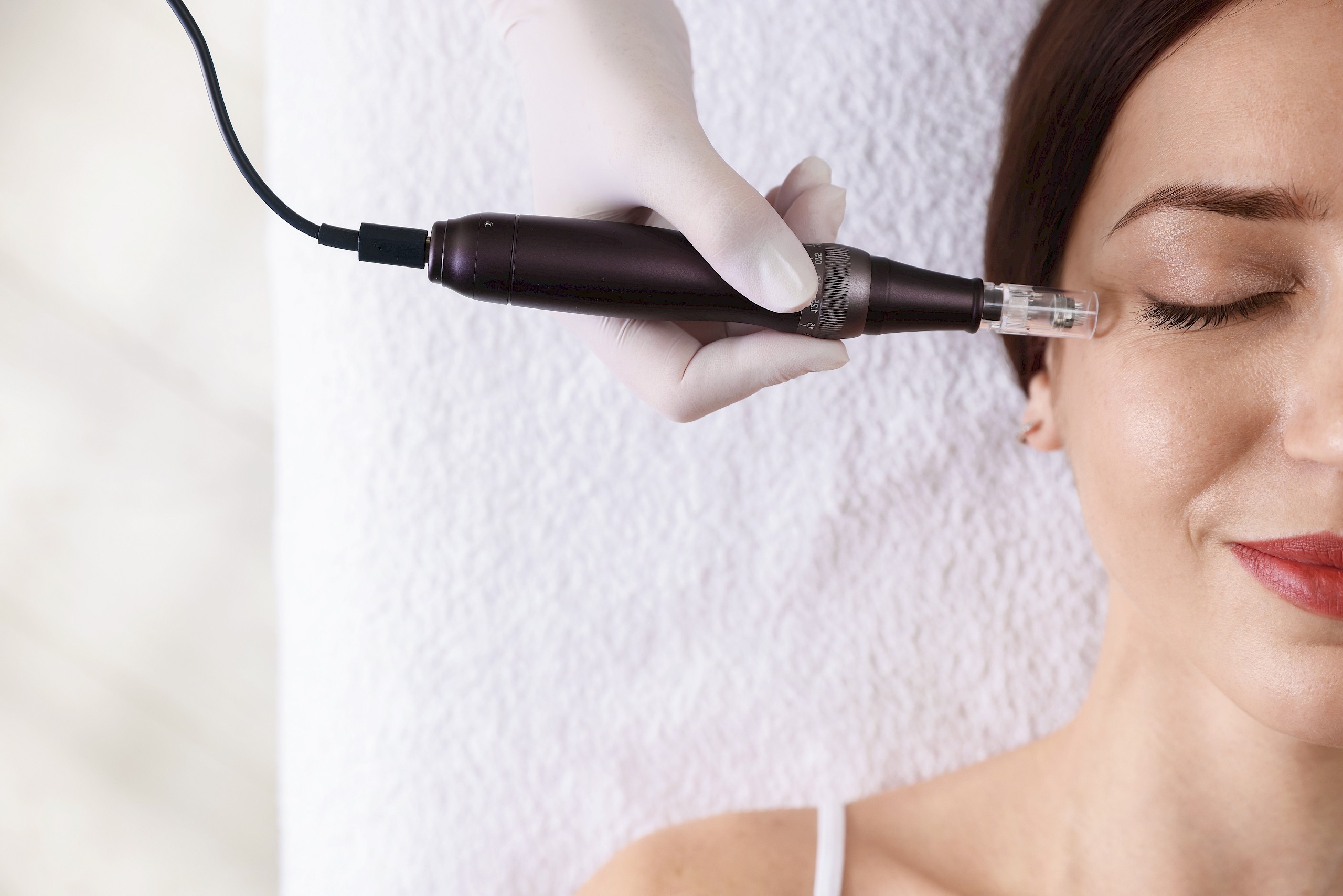 Mi az a microneedling? Így működik a népszerű bőrmegújító kezelés