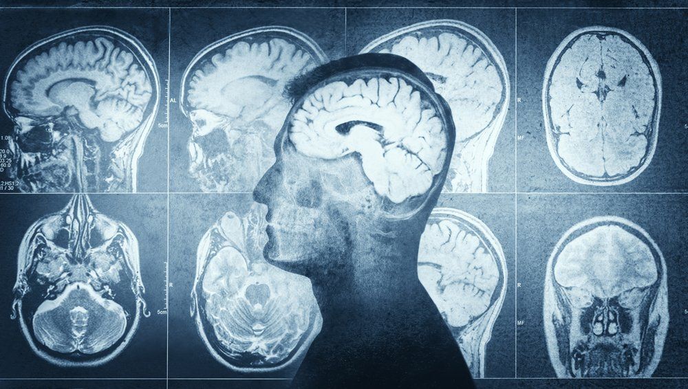 Ennyi idő kell, hogy az agyad helyreálljon a túlzott alkoholfogyasztástól